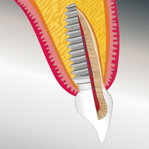 Implantat Vergleich zum natürlichen Zahn